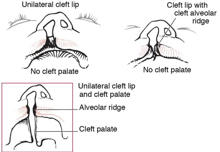 Cpt code for cleft lip repair