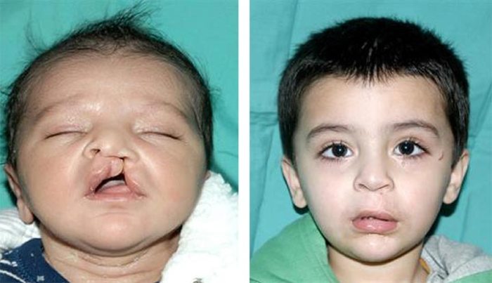 Cleft lip palate after before repair stages patient lift information years bilateral