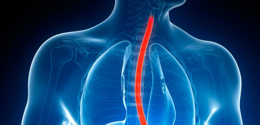 Match the following barrett's esophagus