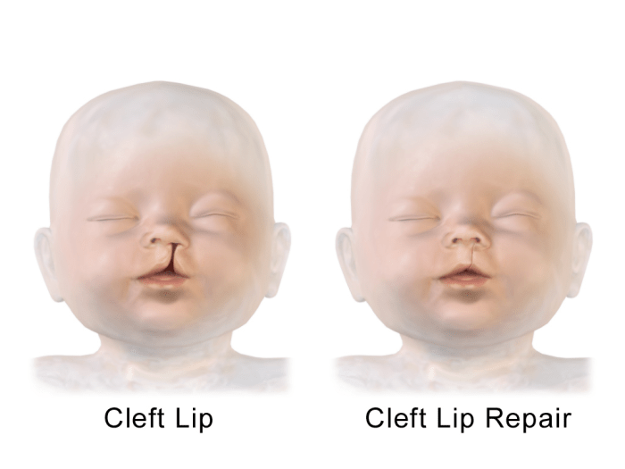 Cleft lip repair deformity nasal before after child incomplete unilateral treatment