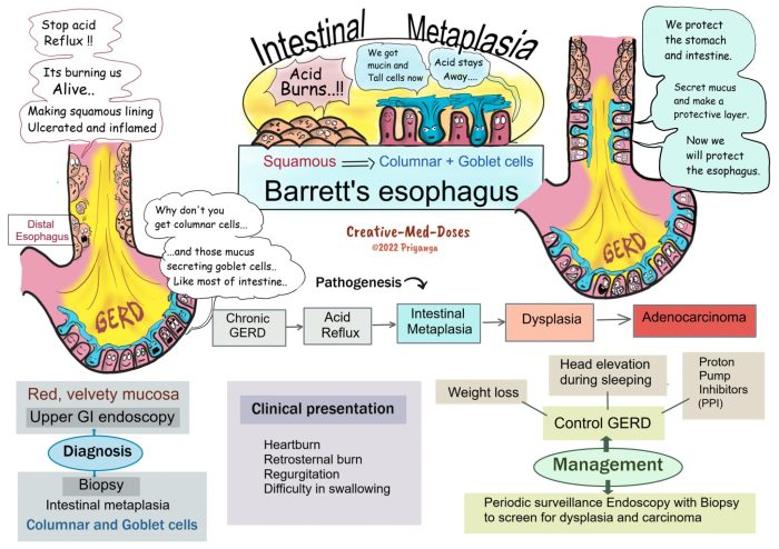 Match the following barrett's esophagus