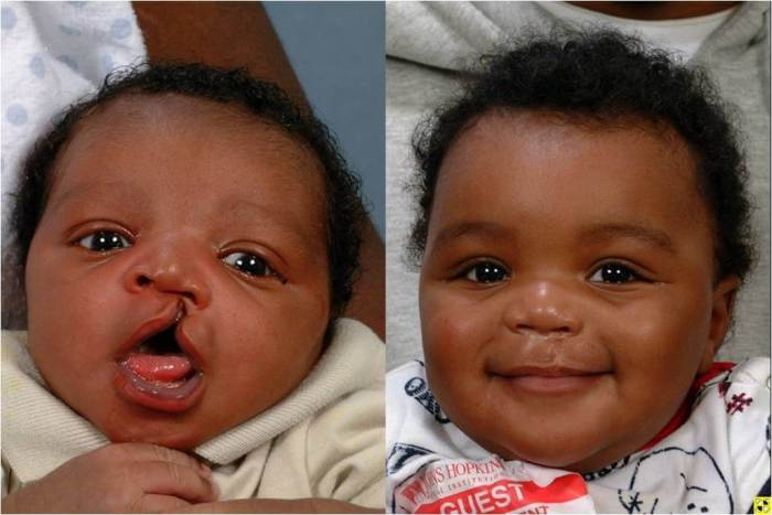 Cleft palate